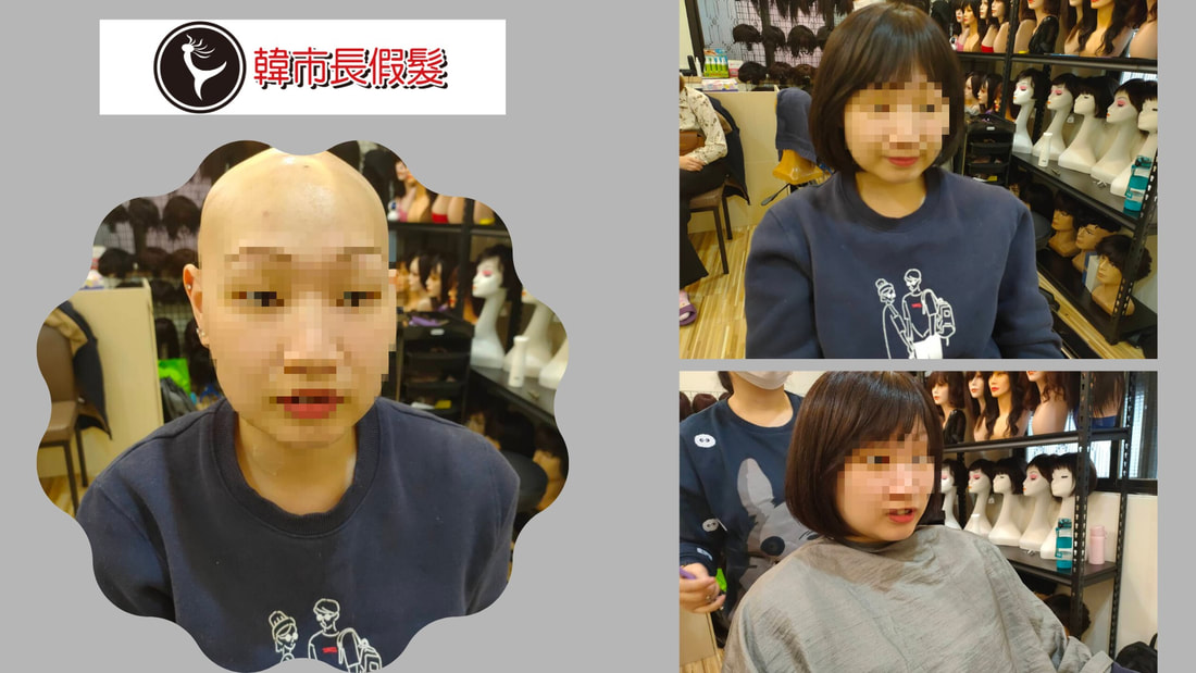 不知名原因落髮假髮前後比較