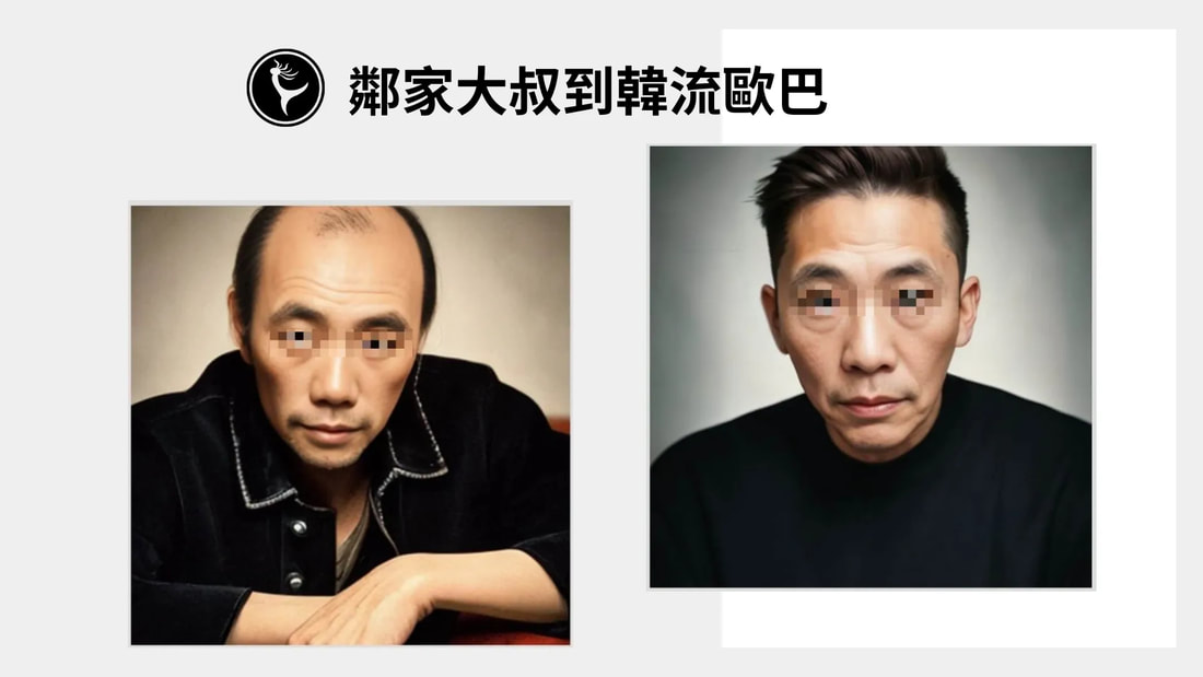 可黏式髮片改善髮際線後移重塑年輕